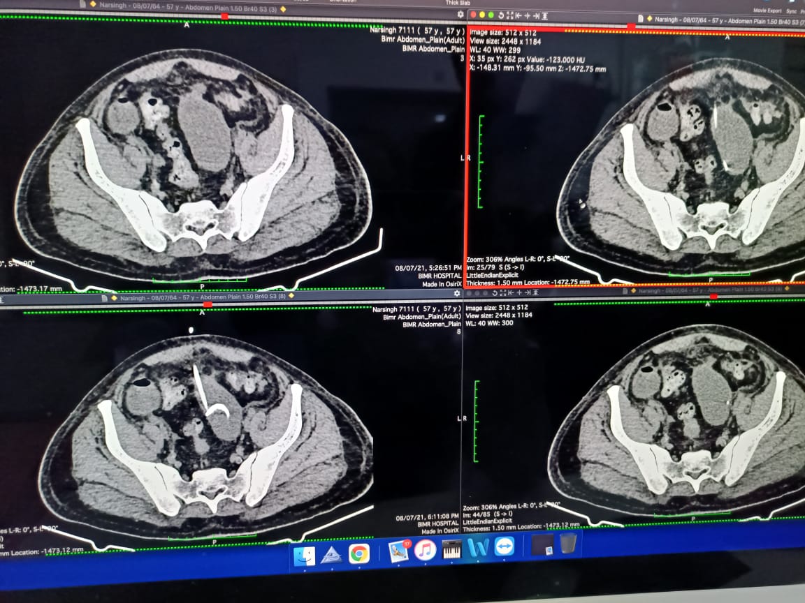 CT Guided Pigtail Insertion in Deep Pelvic Abscess